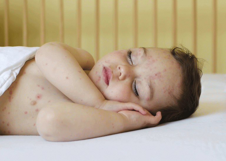 علاج حساسية المضادات الحيوية عند الاطفال علاجها واعراضها